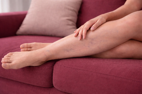 Как отличить варикоз от других сосудистых заболеваний